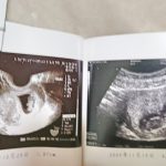 エコー写真は消える！おすすめの保存方法はフォトブック