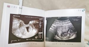 エコー写真は消える!おすすめの保存方法はフォトブック